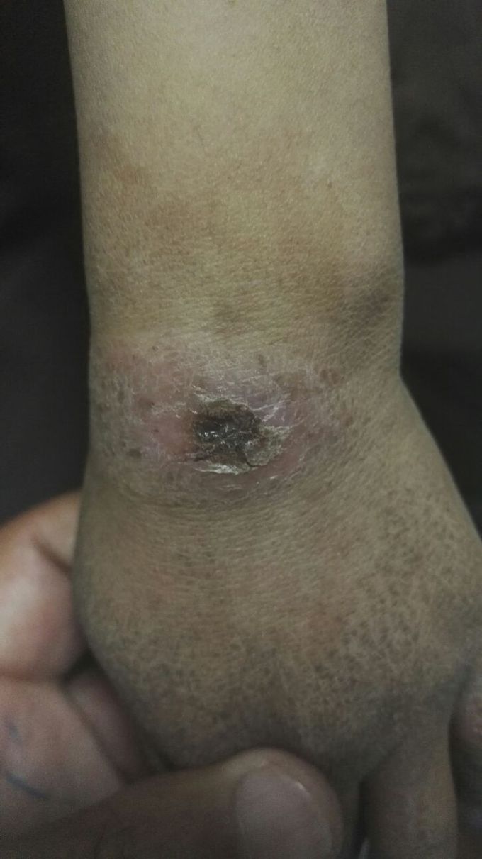 Cutaneous leishmaniasis