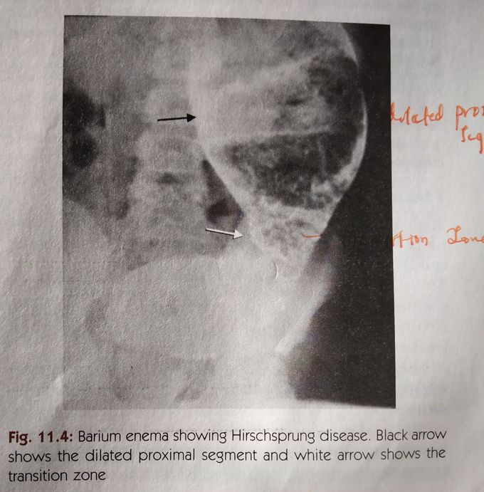 Hirschpung disease on Barium enema