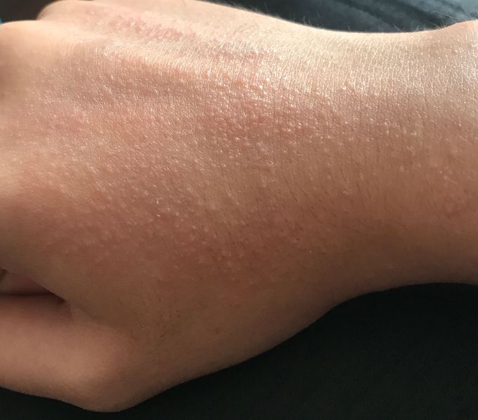 Skin problems