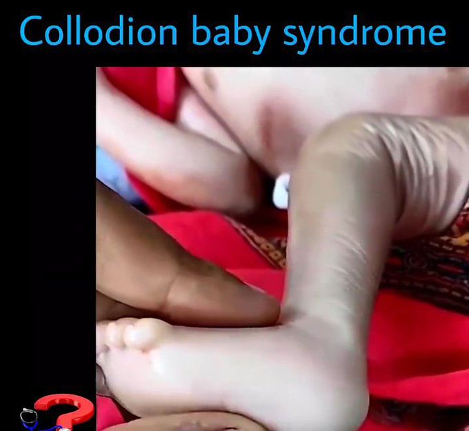 Collodion Baby Syndrome