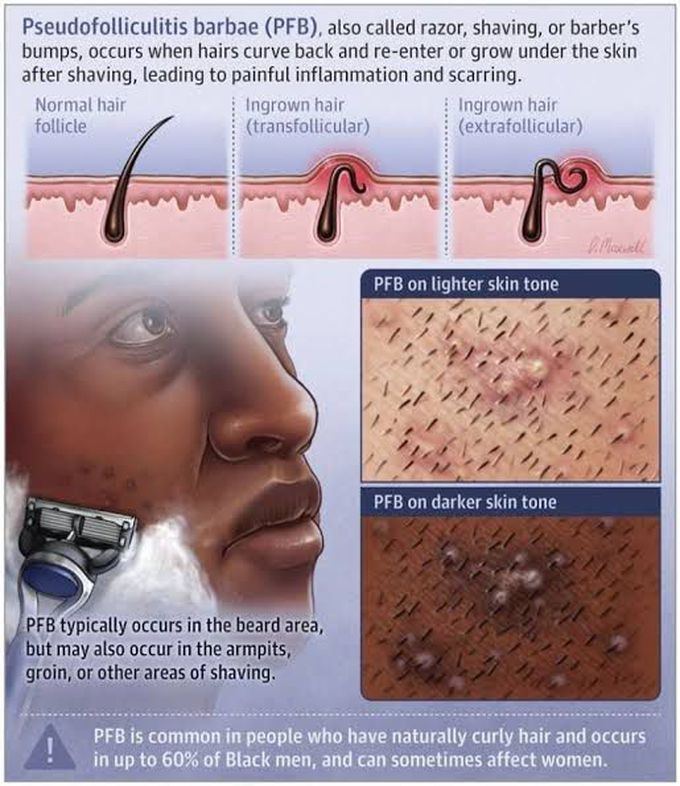 Pseudofolliculitis Barbae