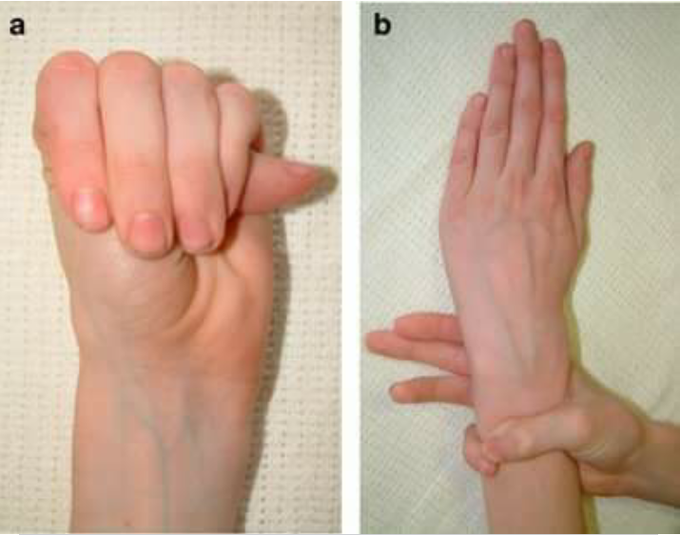 Which syndrome?