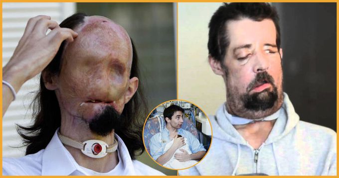 First Man In US Gets Complete Face Transplant And Tells How His Life Has Changed