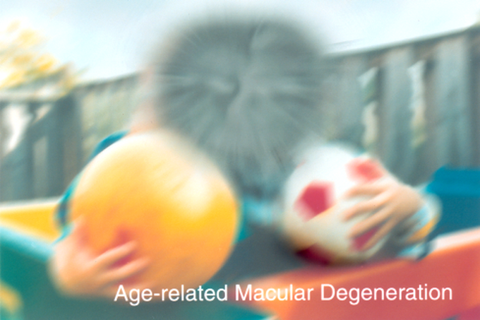 Dry Macular Degeneration