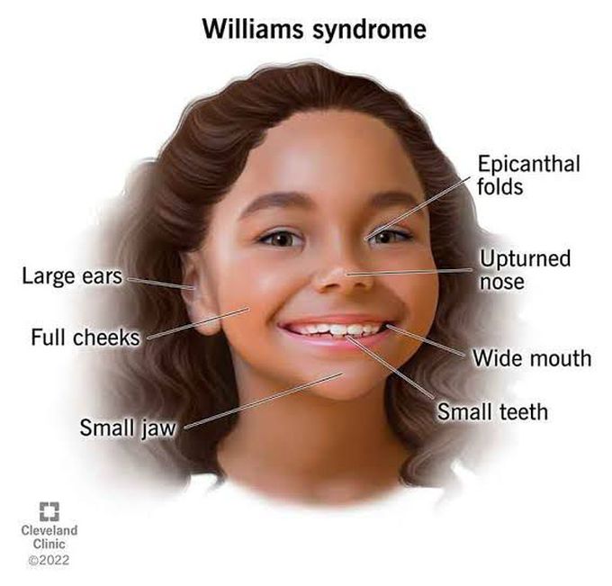Physical Characteristics of William's syndrome