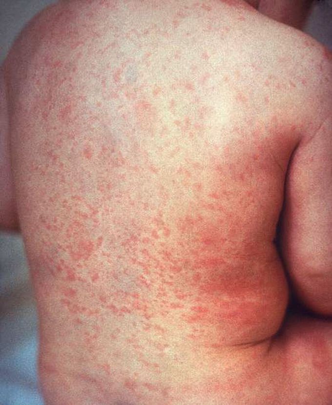 German Measles Symptoms MEDizzy