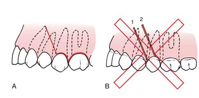 Principles of incision