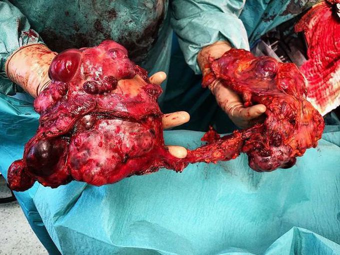 Solid Pseudopapillary Tumor of the Pancreas (SPT)