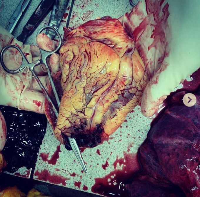 Heart
