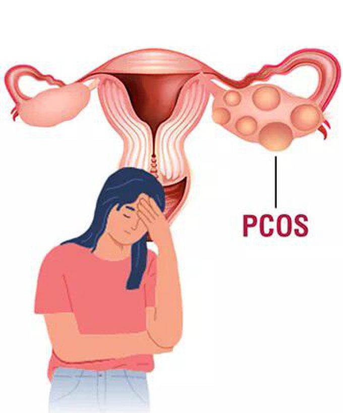 Pcos