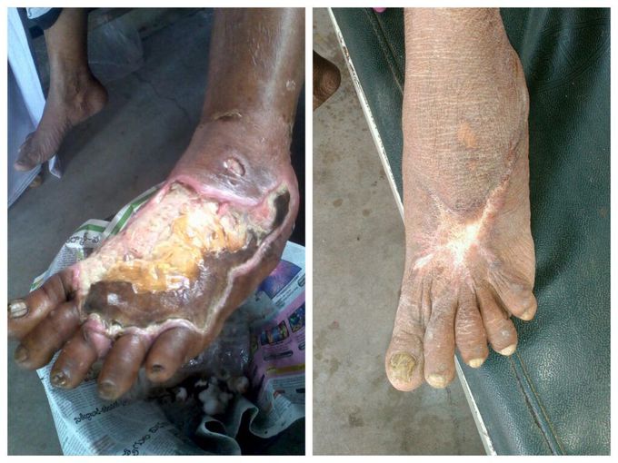 Treatment for Gangrene