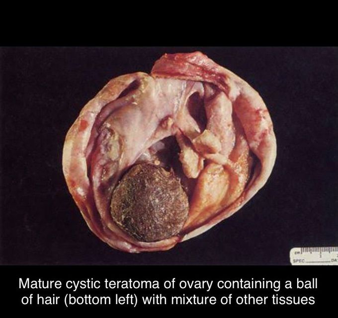 Teratoma of ovary