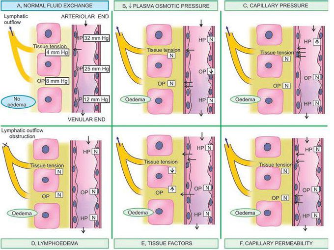 Diagrammatic representation of pathogenesis of oedema