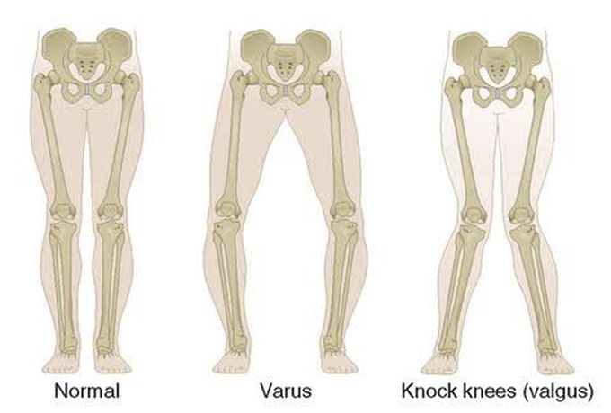 Varus Vs Valgus