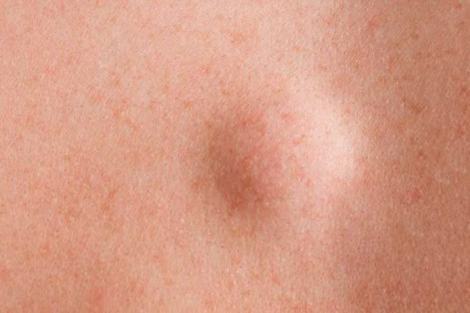 Symptoms of lipoma