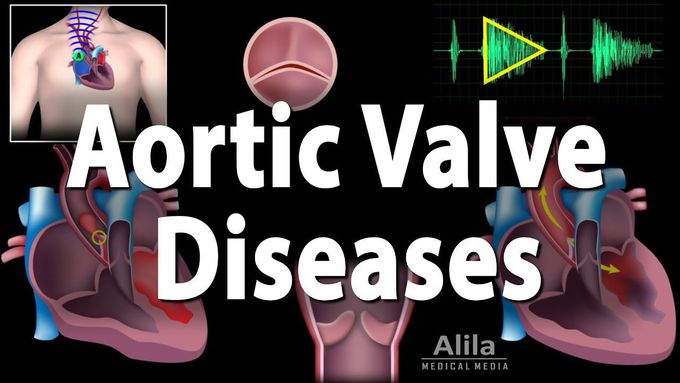 Aortic Valve Disease