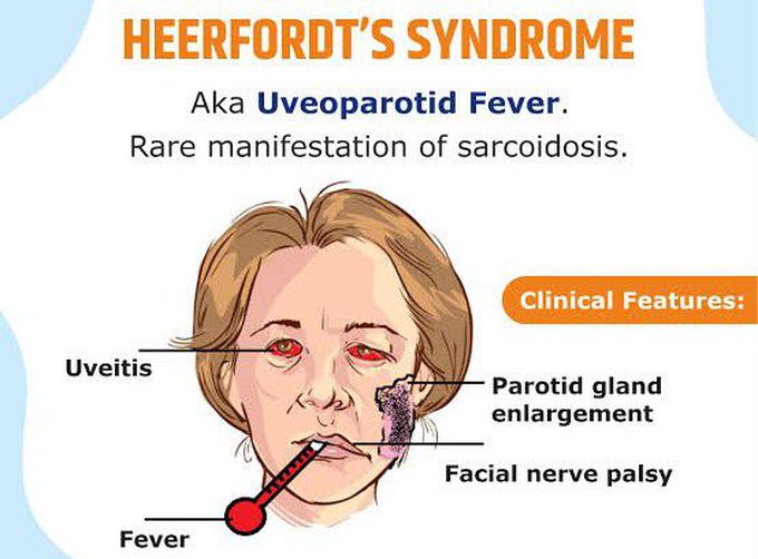 These are the clinical features of Heerfordt's syndrome