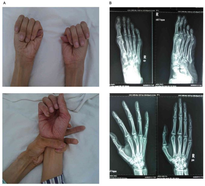 Causes of Arachnodactyly