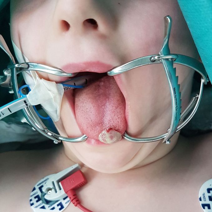 Bening tongue tumor