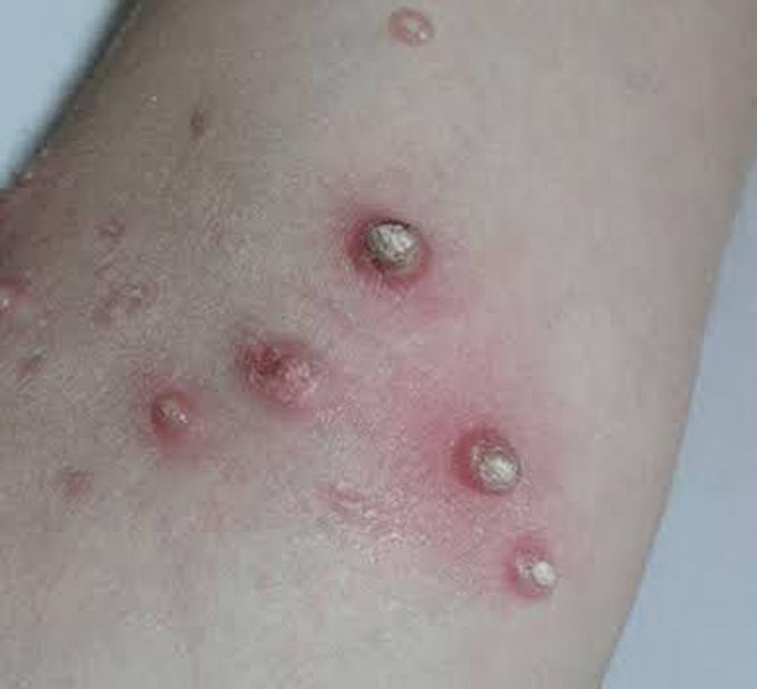 Molluscum Contagiosum