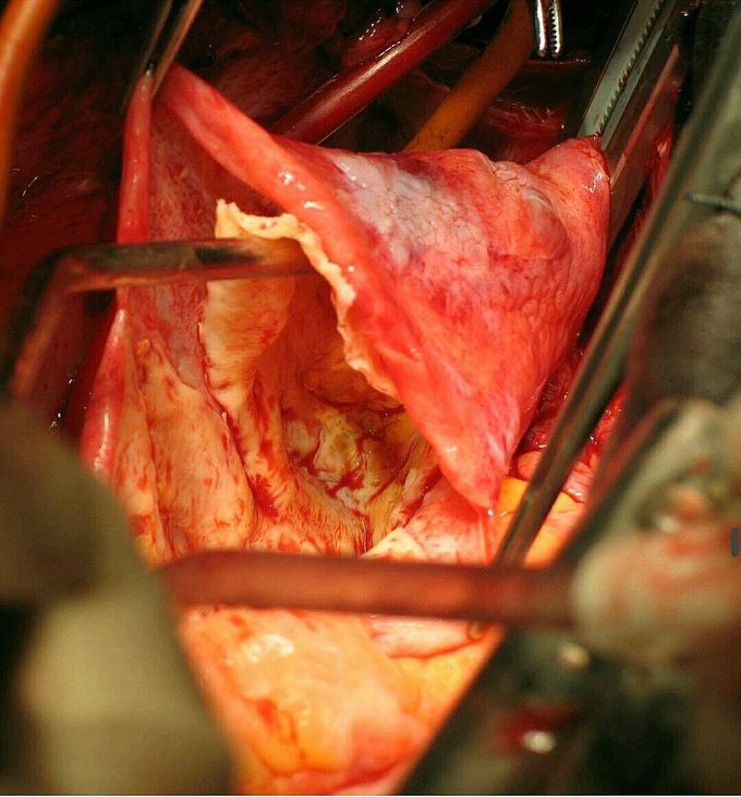 Picture showing aortic dissection