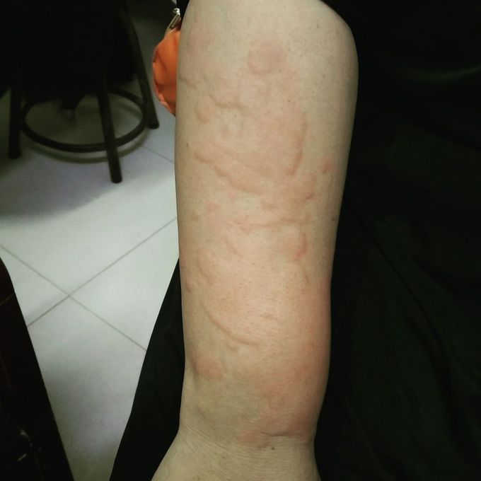Urticaria