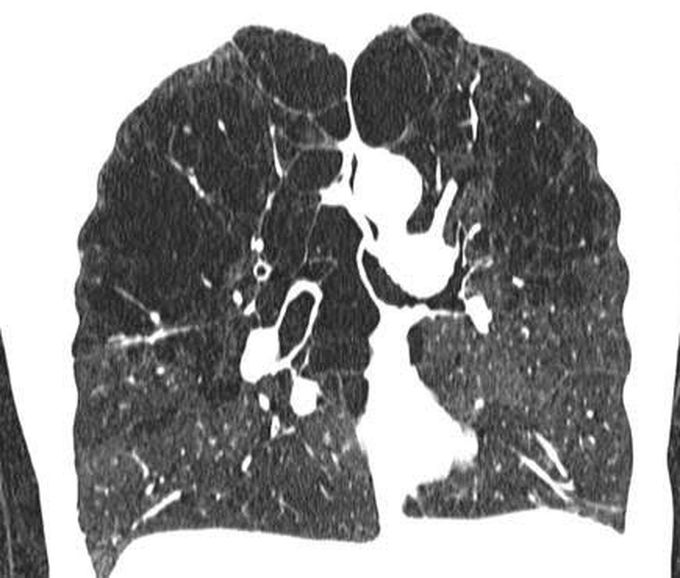 Centrilobular Emphysema