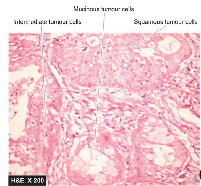 Mucoepidermoid carcinoma.