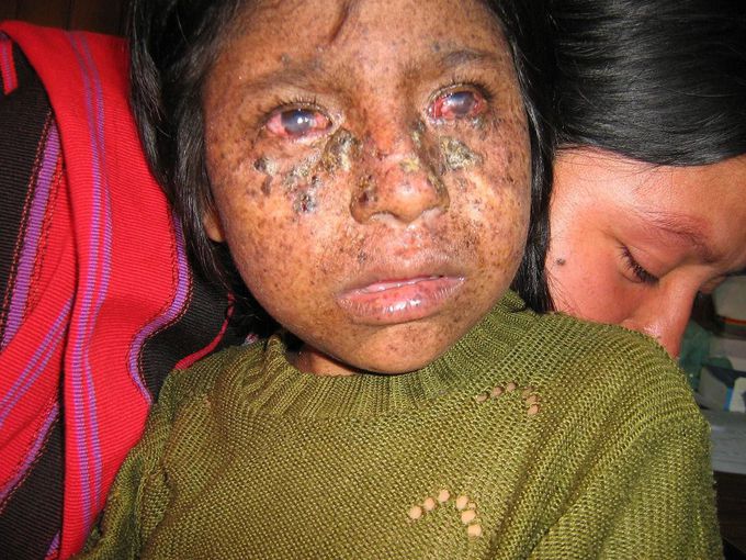 Xeroderma pigmentosum