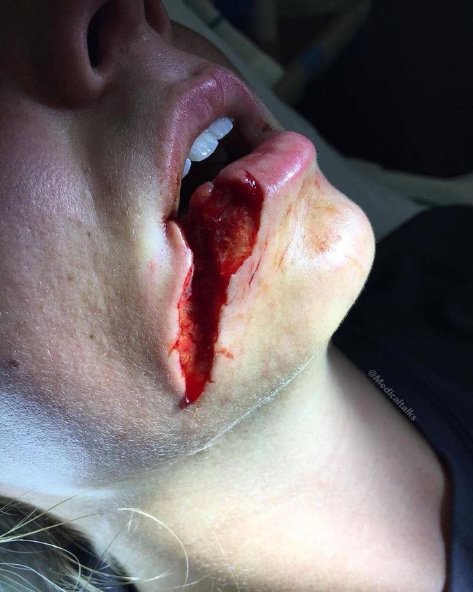 Dog bite