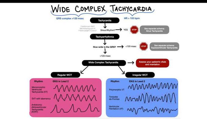 Wide Complex Tachycardia