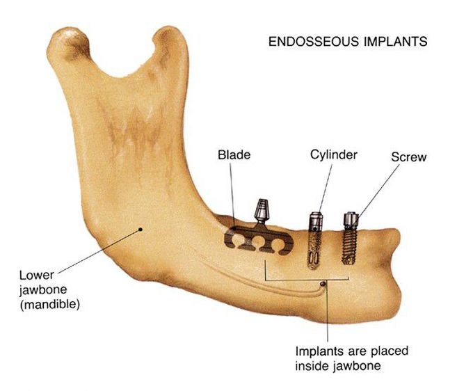 Endosteal implant design