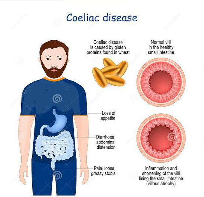 Symptoms of coeliac disease - MEDizzy