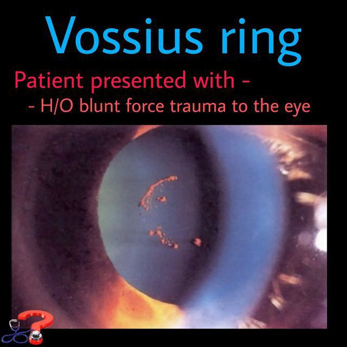 Vossius Ring