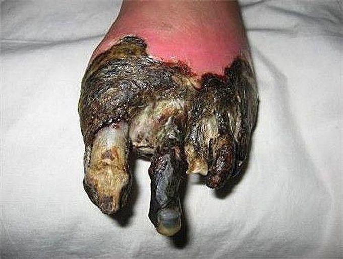 Dry gangrene of the foot as a result of diabetic related complications!!! 