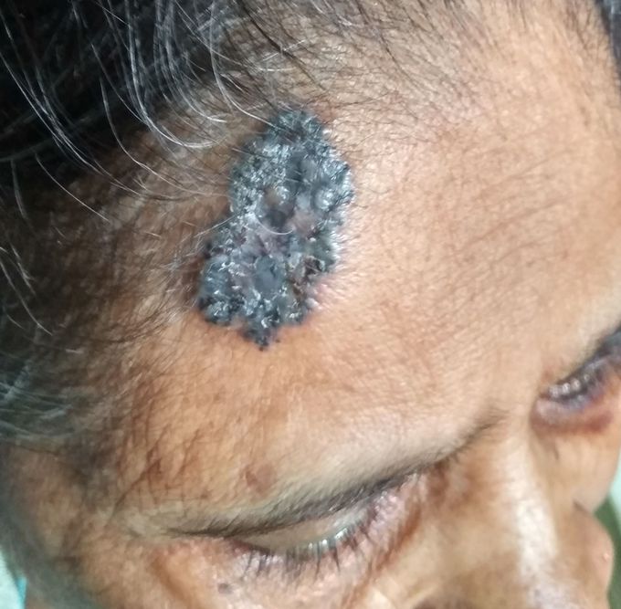 Skin disease