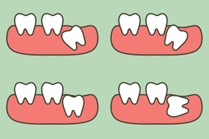 Symptoms of impaction