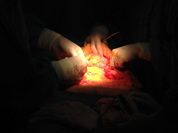 Abdominoplastia