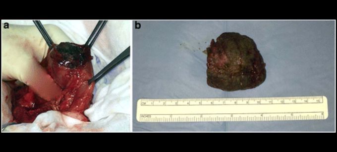 Treatment for Phytobezoar