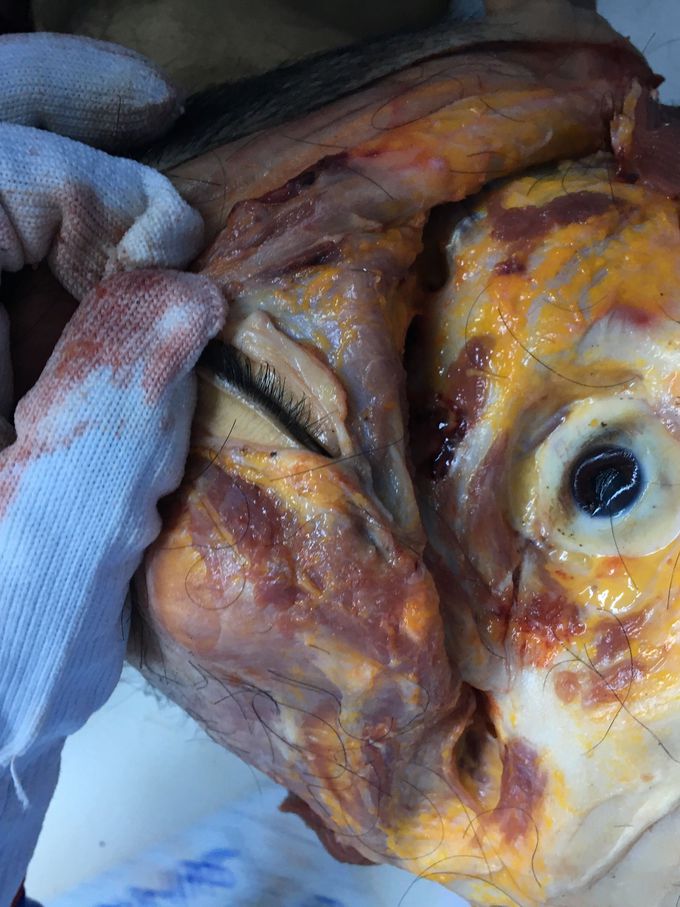 Face disection