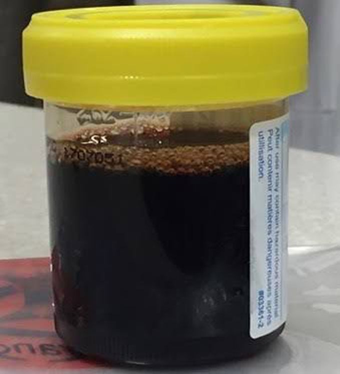 Black urine