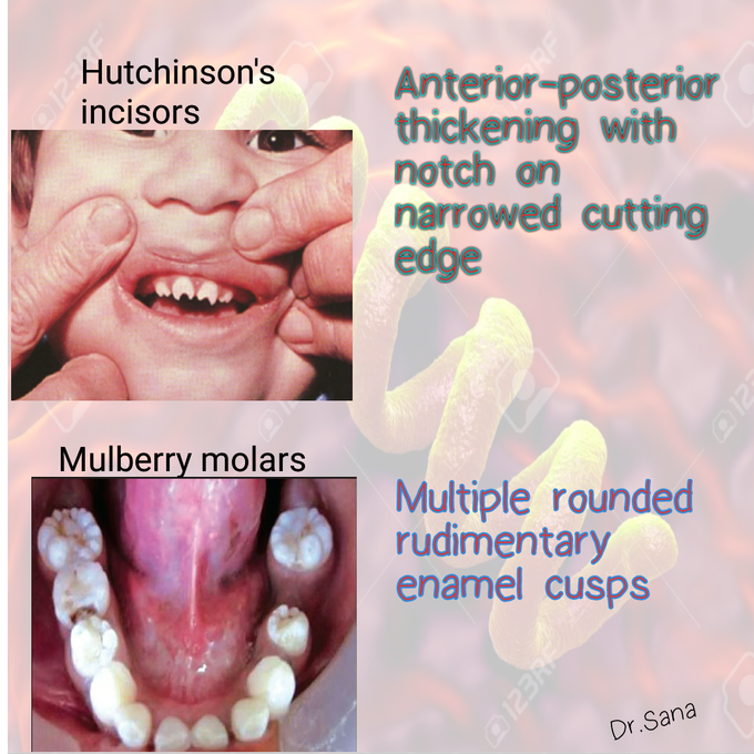 Oral Clinical features of Congenital syphilis