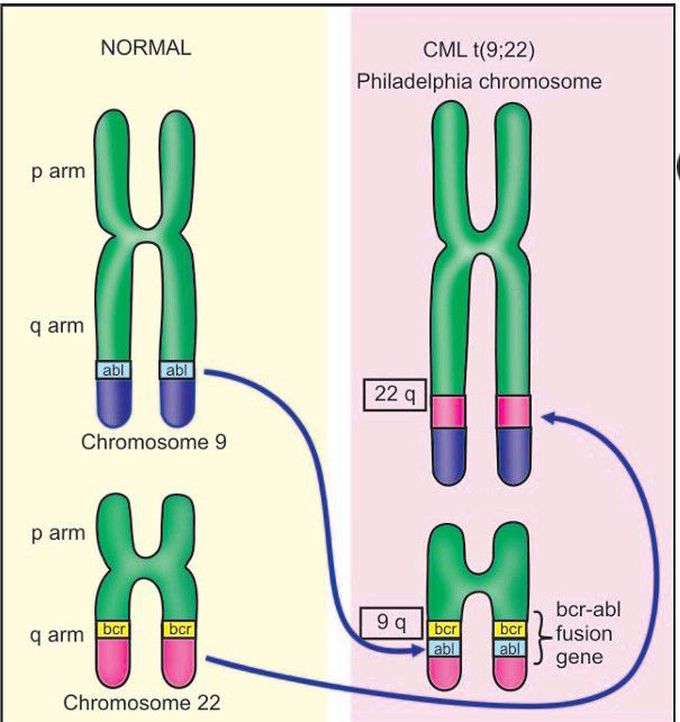 The Philadelphia (Ph) chromosome