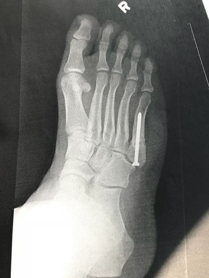 5th metatarsal repair surgery, post op 4 months