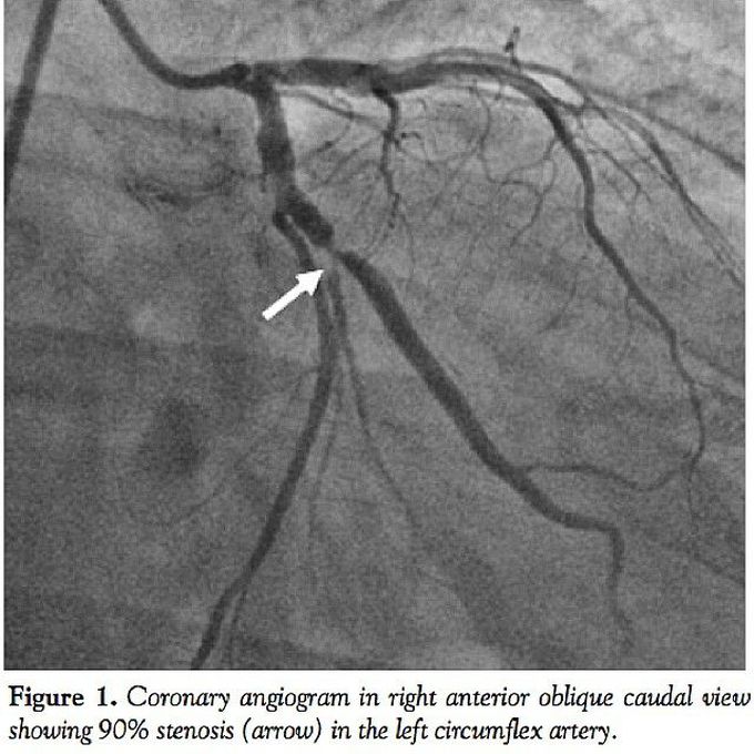 A coronary angiogram showing stenosis of the left circumflex artery