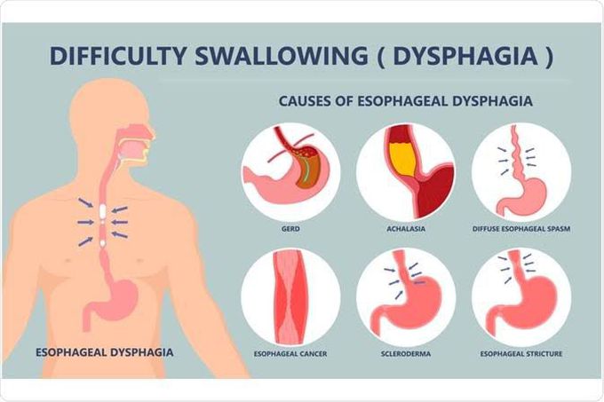 Causes of dysphagia