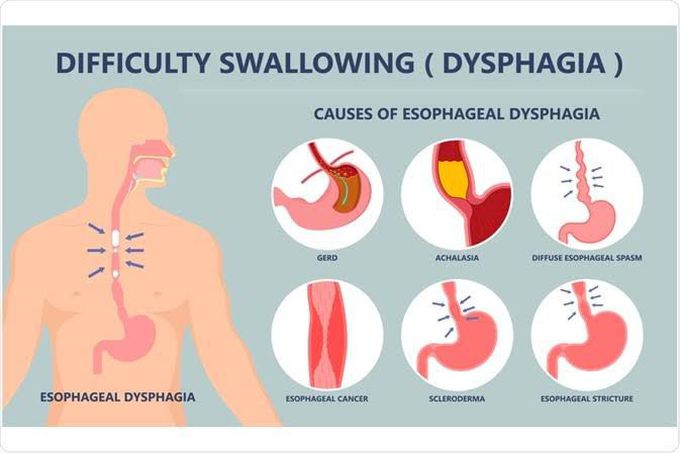 causes of dysphagia