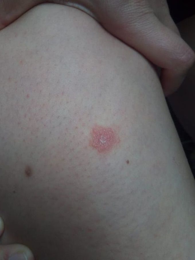 Strange rash that itch