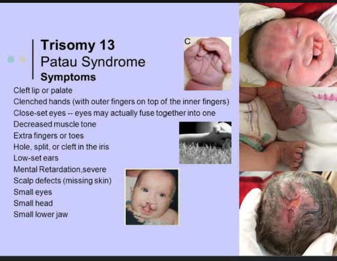 Trisomy 13