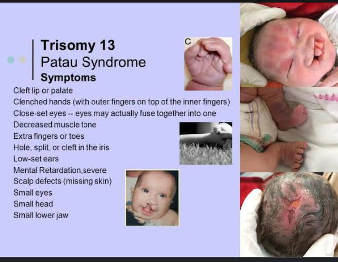 Patau syndrome physical characteristics